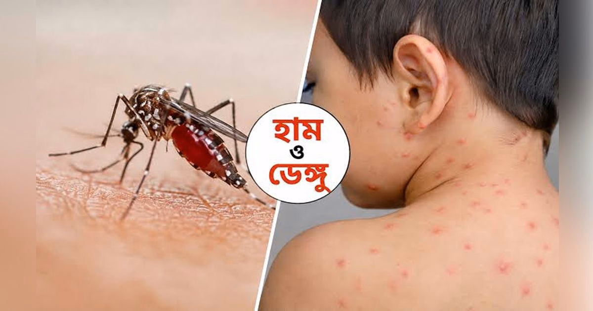 এক দিনে হাম উপসর্গে ৯ ও ডেঙ্গুতে ৬ জনের মৃত্যু